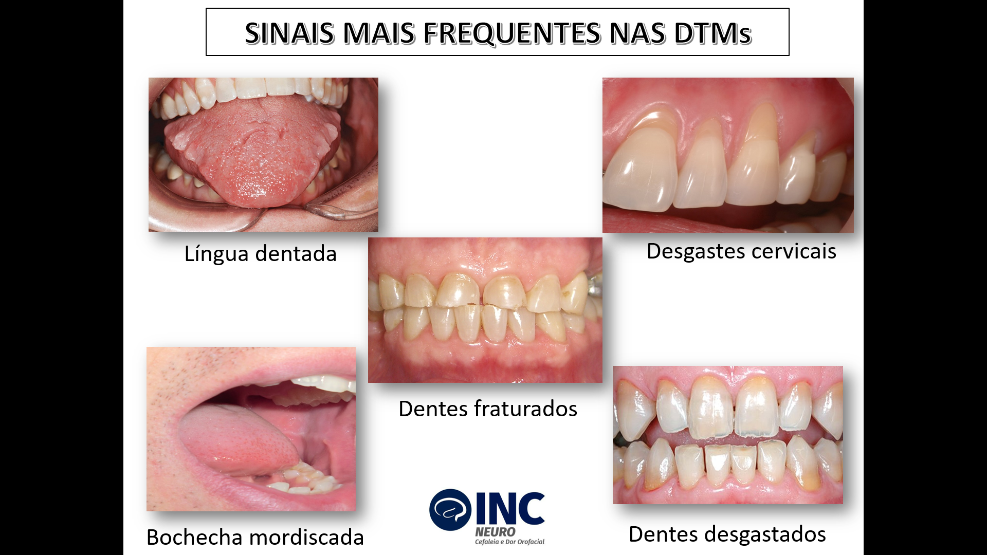 DTM: Entenda o que é a disfunção da Articulação Temporomandibular - Atelier  Dental